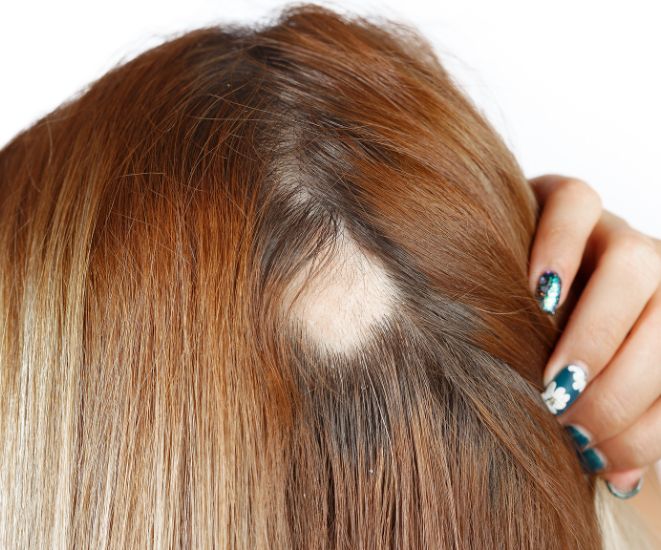 A woman showing a bald spot on the back of her head.
